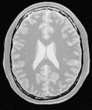 Снимок головного мозга в ходе МРТ